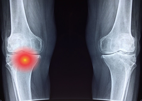 Increasing the visibility of prostate cancer cells in bone