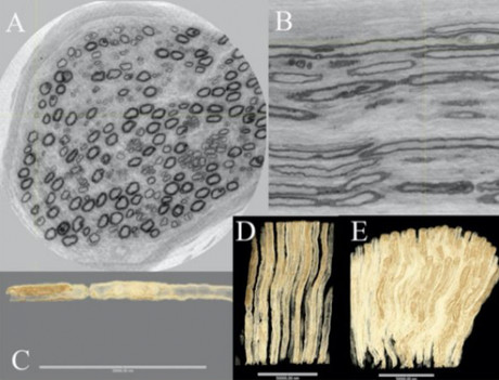 Synchrotron light images nerve fibres in diabetics Synchrotron light images nerve fibres in diabetics