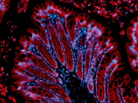 How does the microbiome contribute to liver disease?