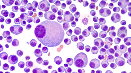 Multiple myeloma triple therapy now on PBS Multiple myeloma triple therapy now on PBS
