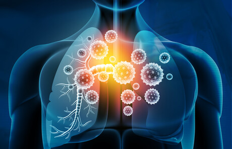 Respiratory infection response: a case of mistaken identity