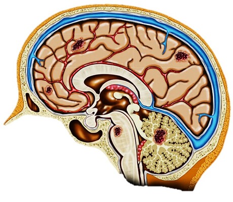 Drug found to treat vascular disorder