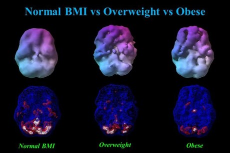 High BMI negatively impacts brain function High BMI negatively impacts brain function