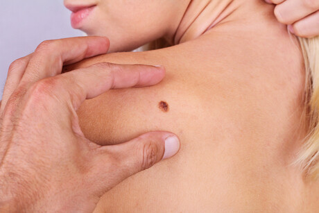 Virtual triage tech identifies skin cancer in high-risk patients Virtual triage tech identifies skin cancer in high-risk patients