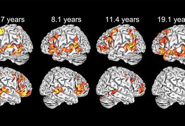 Children use both brain hemispheres to understand language Children use both brain hemispheres to understand language