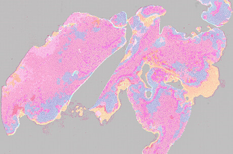 Detecting cancer with AI Detecting cancer with AI