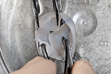 Lab-created heart valves grow with the recipient