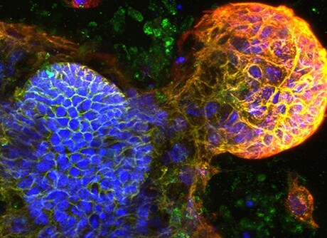 Blood biomarker predicts bowel cancer recurrence