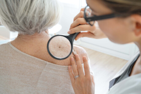 Age explains the genetic mutations of skin cancer