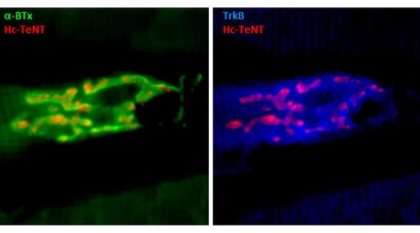 Tetanus neurotoxin could treat depression, Parkinson&#39;s, ALS