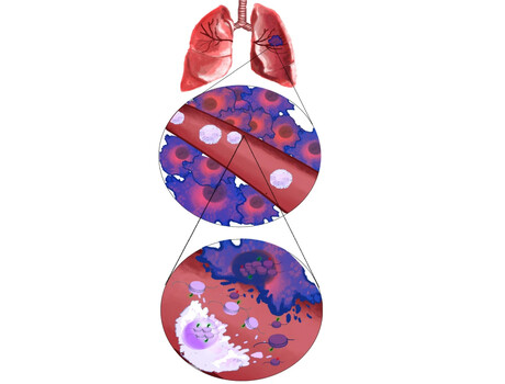 AI blood testing technology can detect lung cancers AI blood testing technology can detect lung cancers