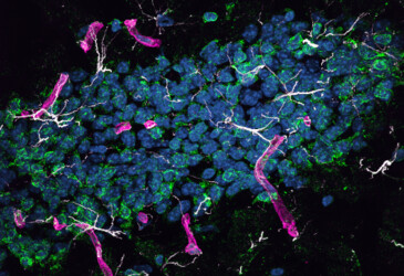 Proteins from the liver may cause Alzheimer's in the brain Proteins from the liver may cause Alzheimer's in the brain