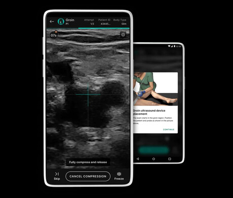 Machine learning algorithm diagnoses deep vein thrombosis Machine learning algorithm diagnoses deep vein thrombosis