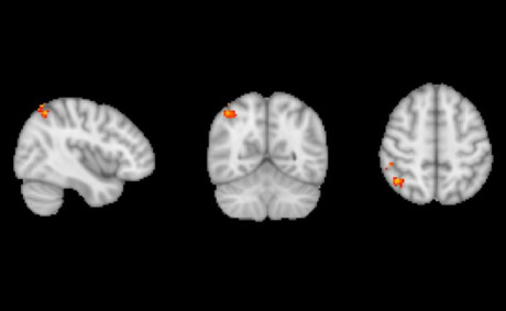 Intestinal drug found to boost memory and cognition