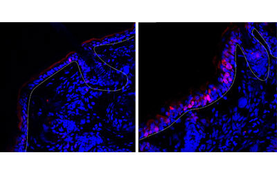 Ineffective psoriasis drugs block the wrong mechanism Ineffective psoriasis drugs block the wrong mechanism