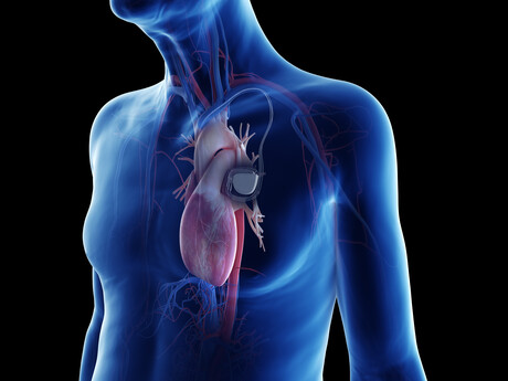 'Bionic' pacemaker reinstates heart rate variability 'Bionic' pacemaker reinstates heart rate variability
