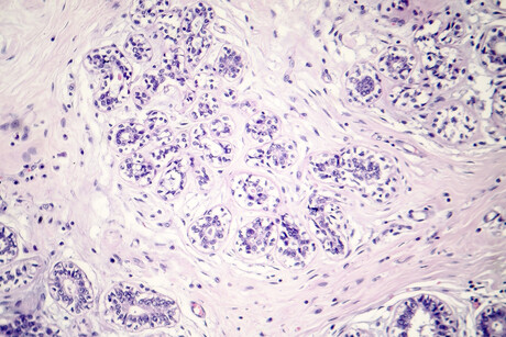 BPA substitute may promote breast tumour progression