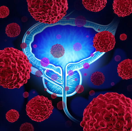 Urine test for bladder cancer could replace cystoscopies Urine test for bladder cancer could replace cystoscopies