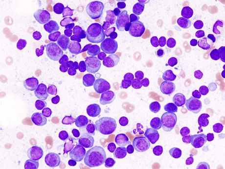 Patrys (ASX:PAB) hits myeloma trial milestone 