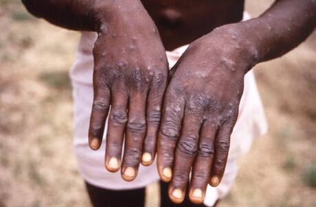 Monkeypox cases confirmed in NSW, Victoria Monkeypox cases confirmed in NSW, Victoria