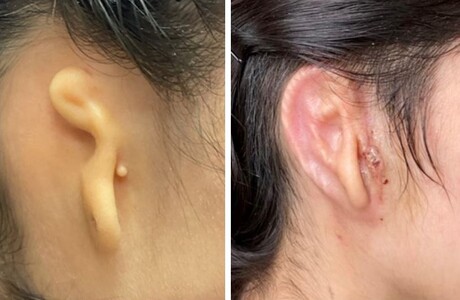 Human ear reconstructed with 3D-bioprinted implant