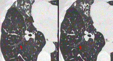 Photon-counting CT detector receives FDA approval Photon-counting CT detector receives FDA approval