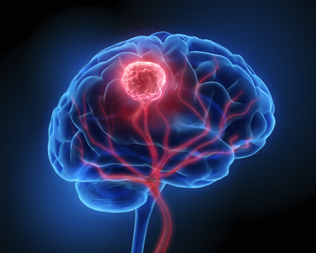 Deadly brain tumours can be starved of their energy source