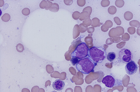 Acute myeloid leukaemia &#39;invisible&#39; to the immune system