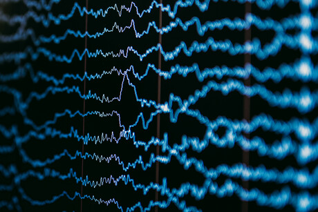 The role of neurofeedback in treating trauma The role of neurofeedback in treating trauma