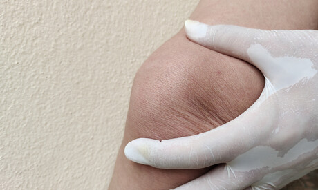 Call to action needed for knee joint health: Monash