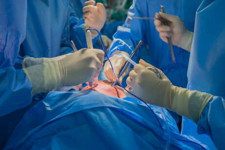 Uncovered: the cause of brain injury after heart surgery Uncovered: the cause of brain injury after heart surgery