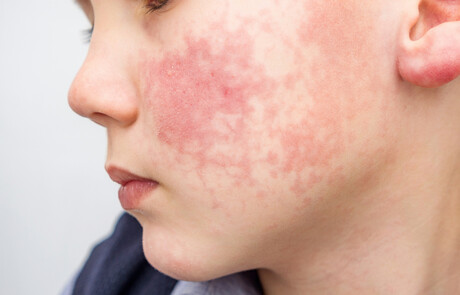 Around 6% of kids and teens are living with eczema: research