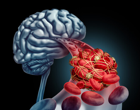 Thrombectomy: possible treatment for large ischemic stroke Thrombectomy: possible treatment for large ischemic stroke