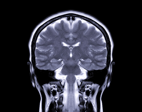 Machine learning helps to assess brain atrophy