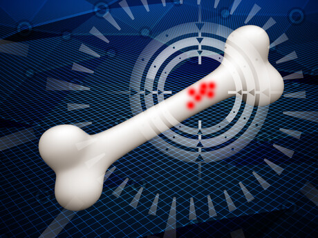 Breakthrough bone cancer drug could increase survival rate Breakthrough bone cancer drug could increase survival rate