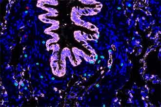 Differences in lung cancer between smokers and non-smokers