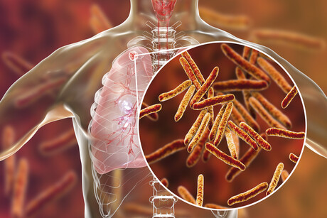 Chip-based technology used to diagnose tuberculosis Chip-based technology used to diagnose tuberculosis