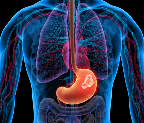 Target found for gastric cancer associated with EBV