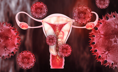 High testosterone levels increase endometrial cancer risk High testosterone levels increase endometrial cancer risk