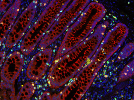Immune cell discovery sparks hope for bowel cancer patients Immune cell discovery sparks hope for bowel cancer patients