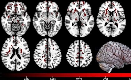 New tools to diagnose traumatic brain injury, predict recovery