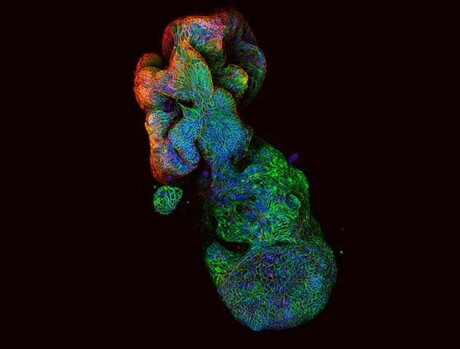 Bowel cancer drugs tested on tumour organoids