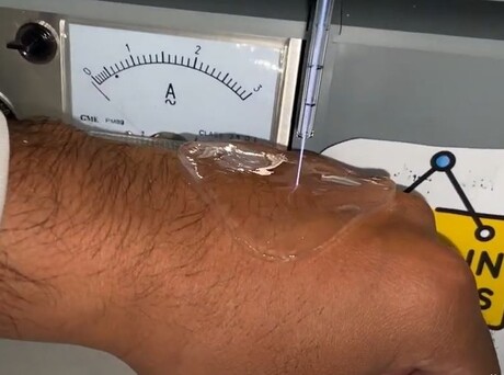 Plasma treatment used to heal chronic wounds Plasma treatment used to heal chronic wounds