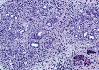 Oral bacteria accelerate pancreatic cancer in mice