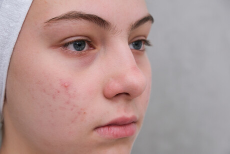 Midnight Health, L&#39;Or&eacute;al partner for acne trial
