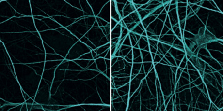 Gene therapy for frontotemporal dementia