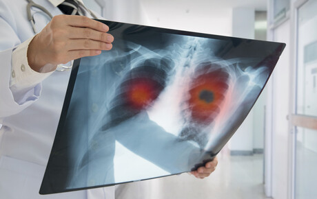Drug trial results show lung cancer patients are living longer Drug trial results show lung cancer patients are living longer
