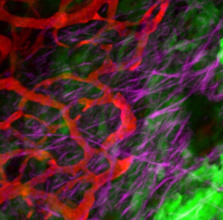 A promising new molecular target for pancreatic cancer