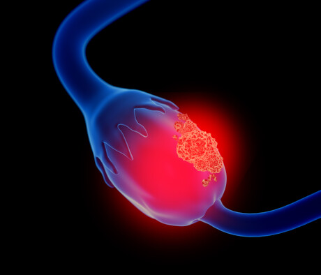 Iron-binding drug could be used to treat ovarian cancer Iron-binding drug could be used to treat ovarian cancer