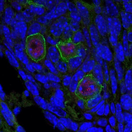 <em>BRCA1</em> gene mutation may increase risk of impaired fertility